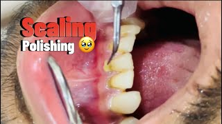 Scaling of anterior teeth with ultra scaler 🥹🇵🇰  Teeth whitening procedure [upl. by Lorie]