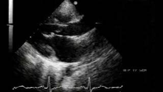 echocardiogramchordal rupture 12 [upl. by Assilam645]