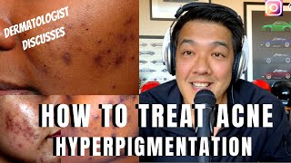 How to treat ACNE PIGMENTATION  PIH [upl. by Fritzsche84]