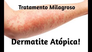 Tratamento para Dermatite Atópica [upl. by Heman]