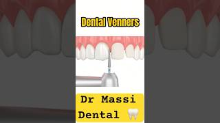 Dental Veneers Cosmetic dental Procedure [upl. by Aihsia]