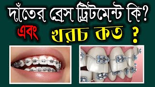 দাঁতে ব্রেস পড়ানোর খরচ কত টাকা  Orthodontics braces treatment cost dental braceby smile bd [upl. by Arahahs20]