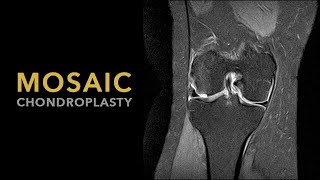 Mosaic Chondroplasty [upl. by Aisayn]