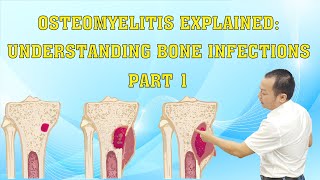 Osteomyelitis Explained Understanding Bone Infections  Part 1 bonehealth [upl. by Rhodie]