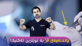 S2E7  چاندنەوەی قژ بە پێشکەوتوترین تەکنیک [upl. by Dorolisa]