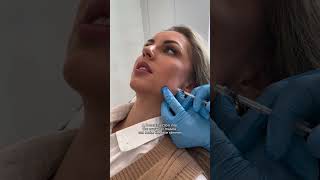 Masseter botox against grinding and clenching [upl. by Greyso813]