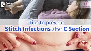 CSection Stitch InfectionsSigns Prevention amp Treatment  Immediate CareDrShashikala Hande of C9 [upl. by Oirrad266]