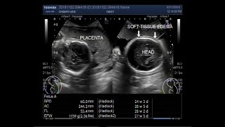 Ultrasound Video showing Microcephaly  small head  associated with microencephaly small brain [upl. by Gabriella]