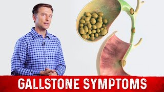 Gallstone Symptoms and Causes Explained – DrBerg on Gallbladder Stone Removal [upl. by Hullda]