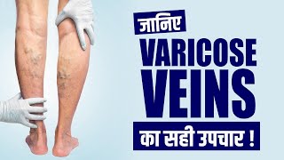 How to Cure Varicose Veins Naturally  Ayurvedic Treatment for Varicose Veins  Shuddhi Ayurveda [upl. by Chip]