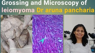 Leiomyoma fibroid grossmicroscopypathology histopathology mbbs uterusproblemeducational [upl. by Marco740]