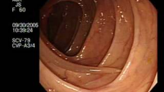 Colonoscopy Demonstrating a Moving Worm  NEJM [upl. by Neelyt]