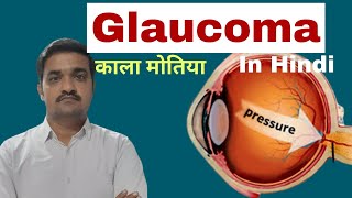 Glaucoma bsc nursing 3rd year  Type symptoms surgery  glaucoma  Nursing Lecture in hindi [upl. by Nimoynib]