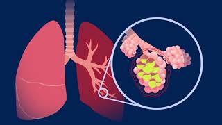 Understanding Pneumococcal Pneumonia [upl. by Fortier]