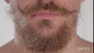 Facial Hair growing for 100 Days in TimeLapse [upl. by Mariquilla]