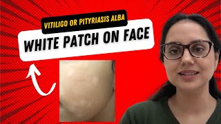 White patch on face Is this Vitiligo or Pityriasis alba II Dr Surbhi MD [upl. by Nyl138]