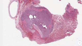 Typical Carcinoid Tumor [upl. by Artnoed]