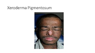 Xeroderma Pigmentosum [upl. by Kiki]