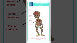 Clinical features of Rickets [upl. by Ellasal]