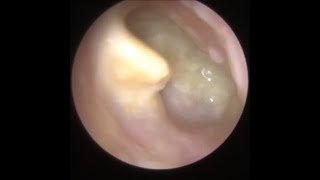 762  Ear Pus Swimmers Ear Infection [upl. by Holder]