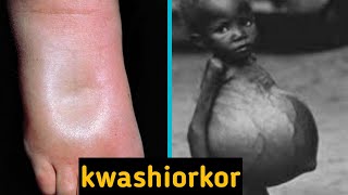 kwashiorkor and its symptoms [upl. by Tomkins]