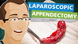 Laparoscopic Appendectomy [upl. by Wrennie]