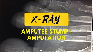 Amputee Stump x ray  Amputation  Amputation on Xray  Hand Amputation  Amputations compilation [upl. by Acnaib]