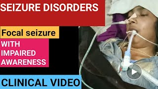 Seizure disorder  focal seizure with impaired awareness [upl. by Muslim]