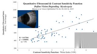 Vitrectomy Improves Visual Function in Multifocal Pseudophakia with Vision Degrading Myodesopsia [upl. by Matti601]