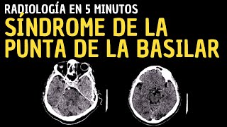 Radiología en 5 minutos Síndrome de la punta de la basilar [upl. by Artapoelc]