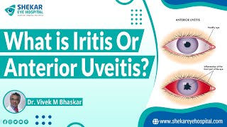 Iritis  Anterior Uveitis  Shekar Eye Hospital [upl. by Ennayelsel]