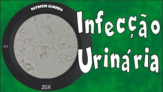 Infecção urinária  Piúria bactérias e muco [upl. by Pain350]