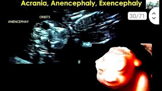 anencephaly 16 सप्ताह के बच्चे का हेडब्रेन brain 🧠 का नही बनना [upl. by Arsi198]