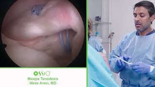 Nirav Amin MD Biceps Tenodesis procedure using OSSIOfiber® [upl. by Eppillihp]