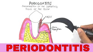 Periodontal Disease  Pathogenesis [upl. by Wilcox69]