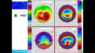 Quick guide to reading corneal tomography Part 6 [upl. by Ilenay613]