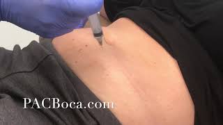 Lipolysis Injections Dr Sharabi PACBocacom [upl. by Nallac]