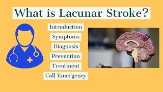 How to treat lacunar Stroke [upl. by Ecinad379]