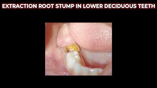 ROOT STUMP EXTRACTION  EXTRACTION ROOT STUMP IN LOWER DECIDUOUS TEETH  DAAT KA JAAD NIKALNA [upl. by Lidda]