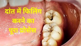 दांत में कीड़े लगने के बाद फिलिंग करने का पूरा प्रोसेस shorts shortvideo dentist youtube [upl. by Ecneitap]