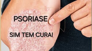 SIM TEM CURA PSORIASE TRATAMENTO TOTALMENTE NATURAL [upl. by Ollehcram282]