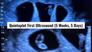 Our First Ultrasound at 5 Weeks amp 5 Days Its Five Finding Out We Were Having Quintuplets [upl. by Orazal646]