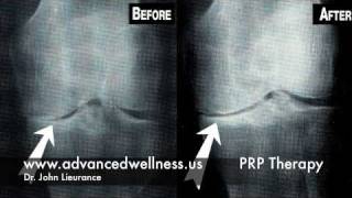 Platelet Rich Plasma Therapy [upl. by Lello562]