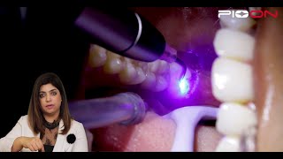 Excision of soft tissue Operculectomy by Pioon S1 Dental Diode Laser [upl. by Eba]