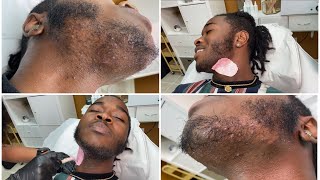 MALE CHIN WAX  INGROWN HAIR REMOVAL  Muva K Aesthetics [upl. by Irat159]