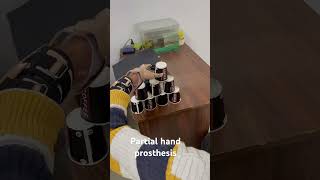 Advanced Functional prosthesis for partial hand amputationHandicare 9310304604 9990621774 [upl. by Aekim]