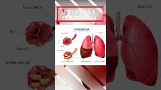 Lung sound in Pneumonia [upl. by Kcirtemed112]