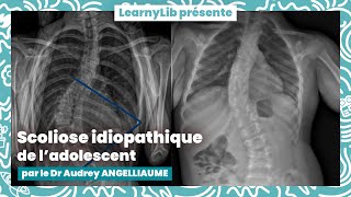 🩺 Pédiatrie  la scoliose idiopathique de ladolescent avec le Dr Audrey ANGELLIAUME [upl. by Rebmetpes773]