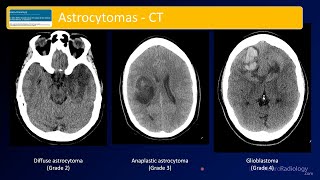 Emergency Imaging of Brain Tumors Astrocytomas [upl. by Mandie]