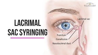 Lacrimal Syringing of the eye  Eye Solutions  The Complete Eye Hospital [upl. by Inama]